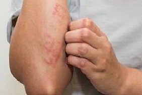 allergiás ekcéma tünetei pikkelysömör kezelése kvarc