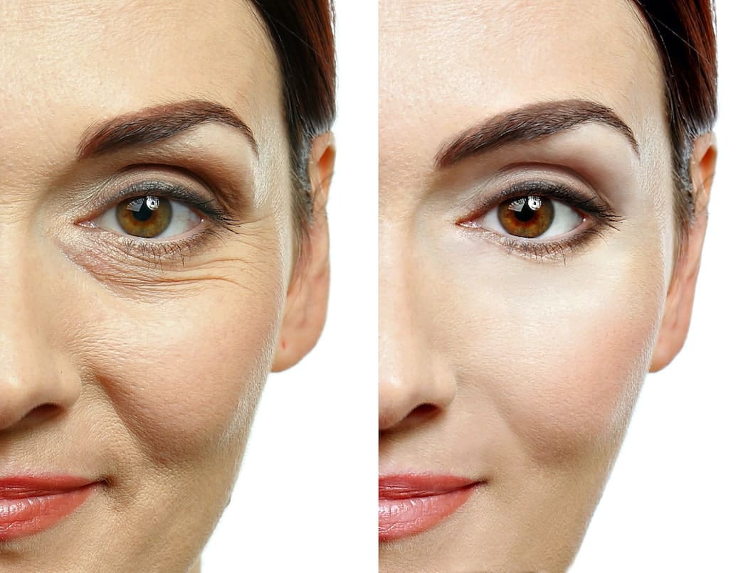 Botox kezelés
