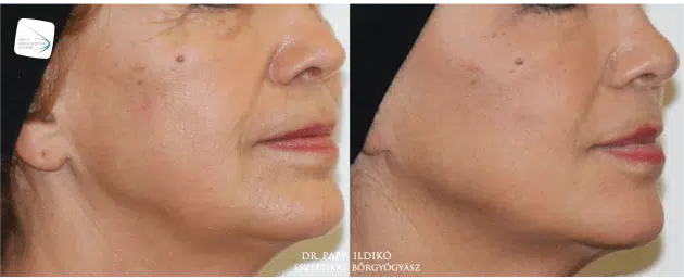 Botox elotte utana
