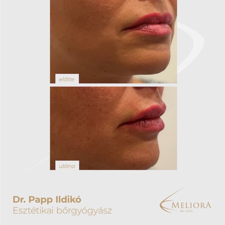 Ajakfeltöltés Előtte-Utána