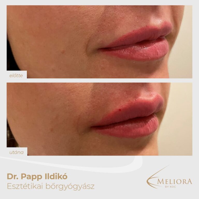 Ajakfeltöltés Előtte-Utána