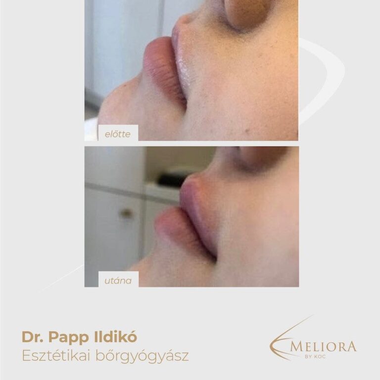 Ajakfeltöltés Előtte-Utána