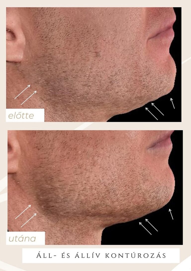 Áll-állív kontúrozás