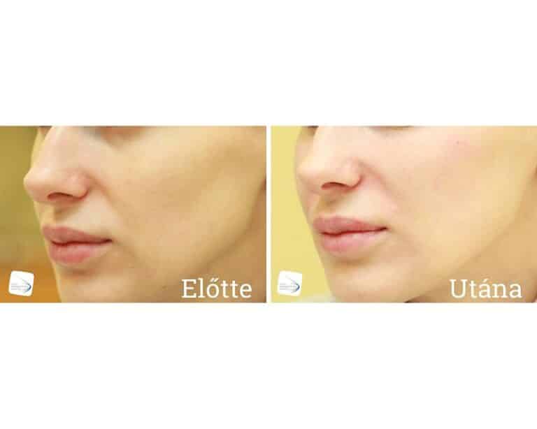 Állív formázás Előtte-Utána