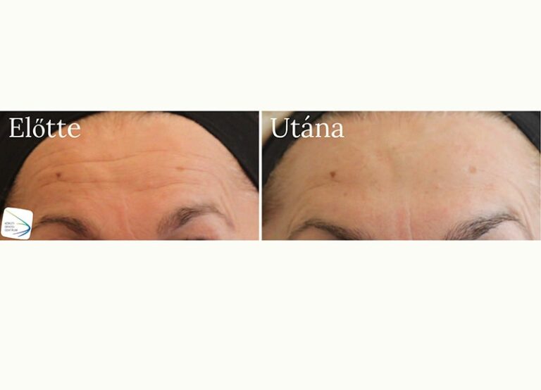 Botox Előtte-Utána