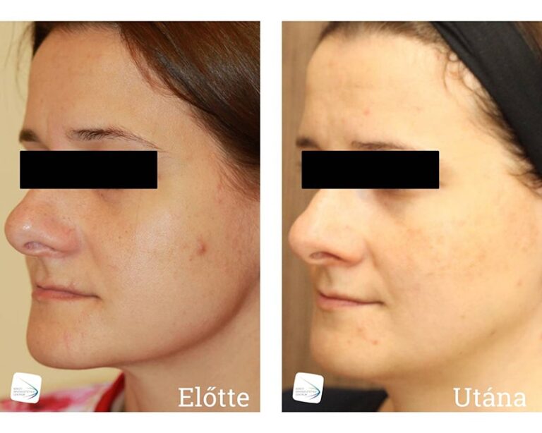 Frakcionált lézerkezelés Előtte-Utána