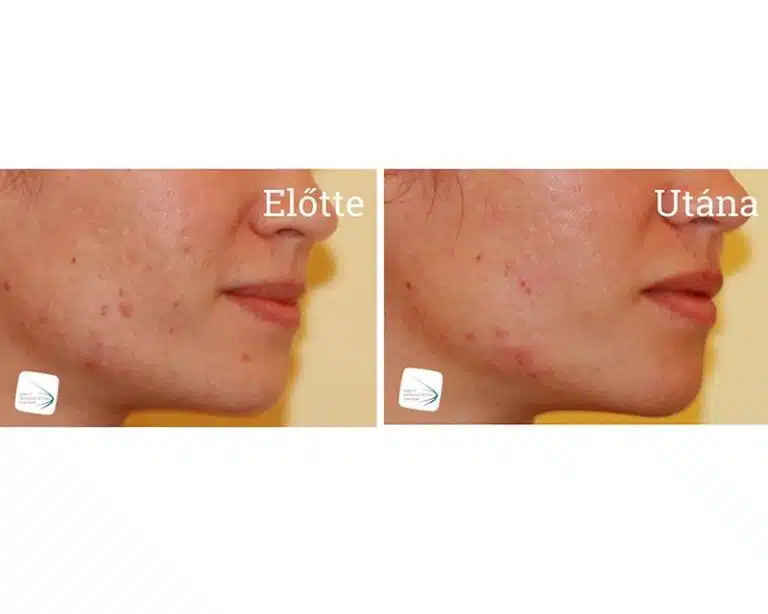 Frakcionált lézerkezelés Előtte Utána