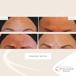 Homlok botox Előtte-Utána