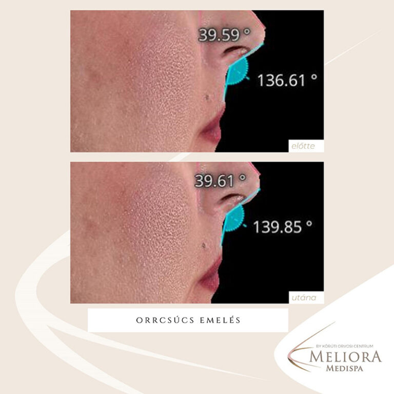 Orrcsúcs emelés Előtte-Utána
