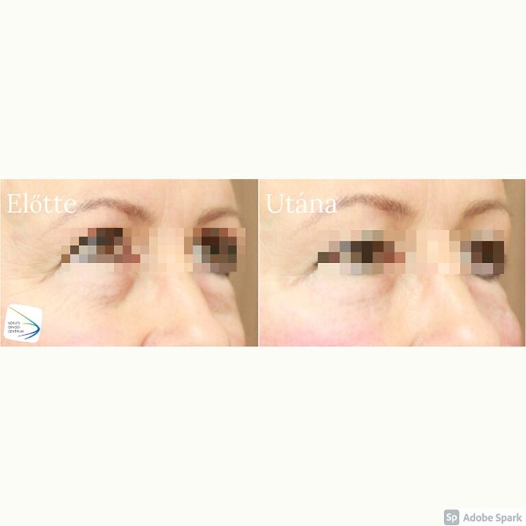 Szem alatti karikák töltése Előtte-Utána