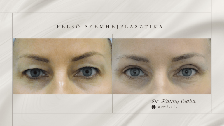 Felső szemhéj előtte-utána