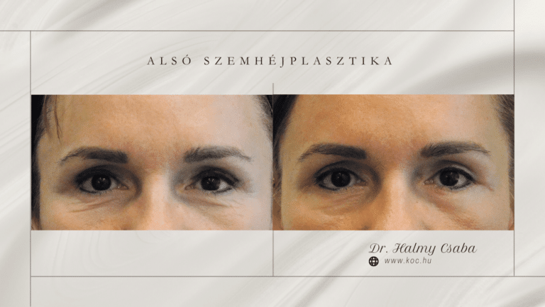 alsó szemhéj előtte-utána