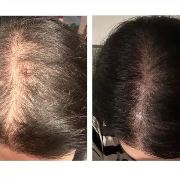 Hajhullás ellen – exosome sejtterápia