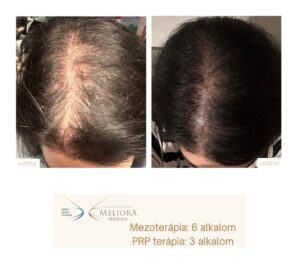 Hajkezelés Előtte-Utána