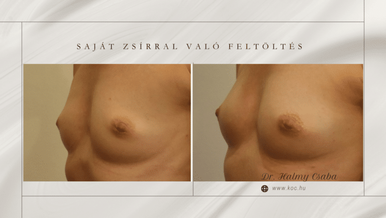 Saját zsírral visszatöltés AFG előtte-utána