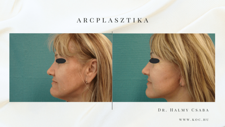 Arcplasztika Előtte-Utána