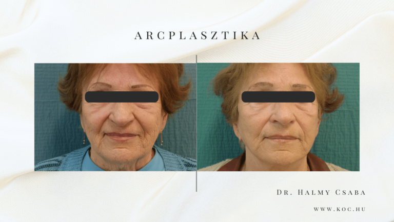 Arcplasztika Előtte-Utána