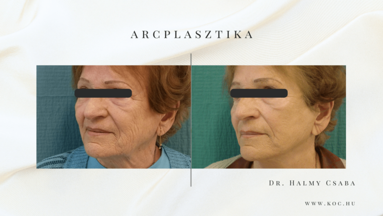Arcplasztika Előtte-Utána