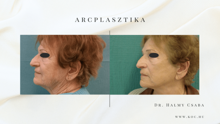 Arcplasztika Előtte-Utána