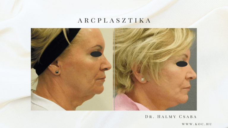 Arcplasztika Előtte-Utána