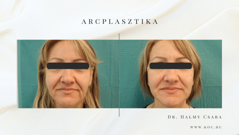 Arcplasztika Előtte-Utána