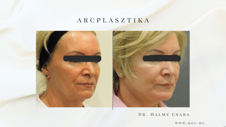 Arcplasztika Előtte-Utána