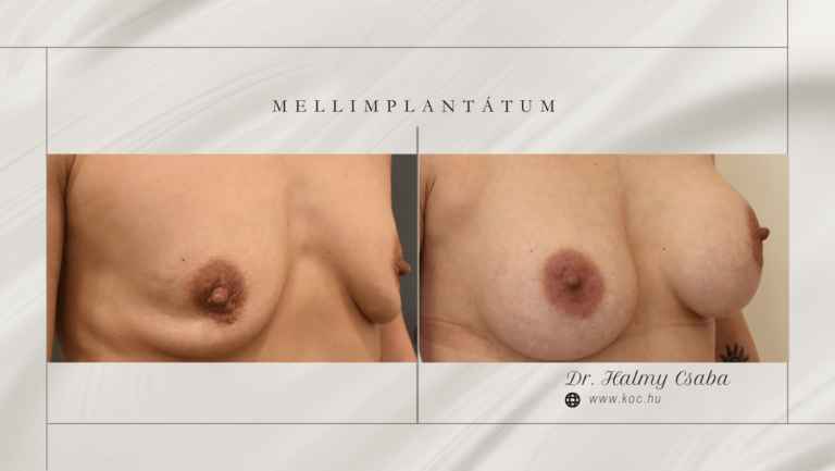 Augmentatio Előtte-Utána