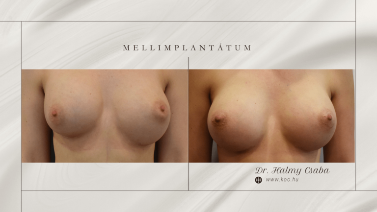 Augmentatio Előtte-Utána