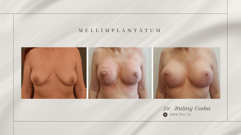 Augmentatio Előtte-Utána