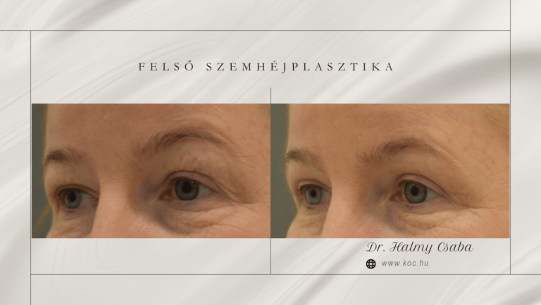 Felső szemhéj előtte-utána