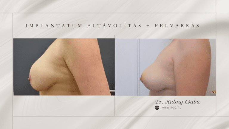 Implantatum eltávolítás, felvarrás előtte-utána