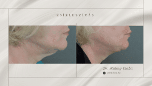 Toka zsírleszívás előtte utána